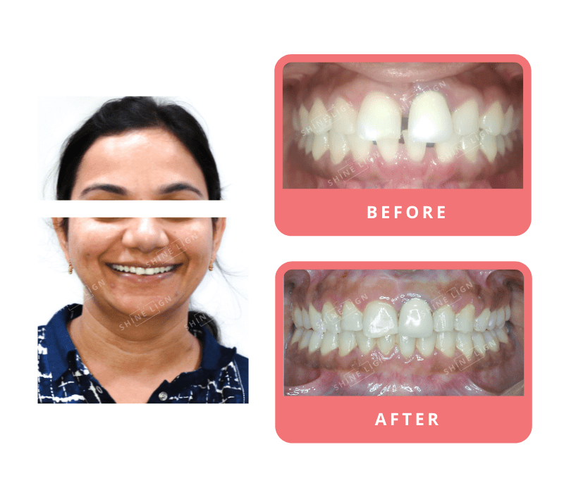 Shinelign Clear Aligner