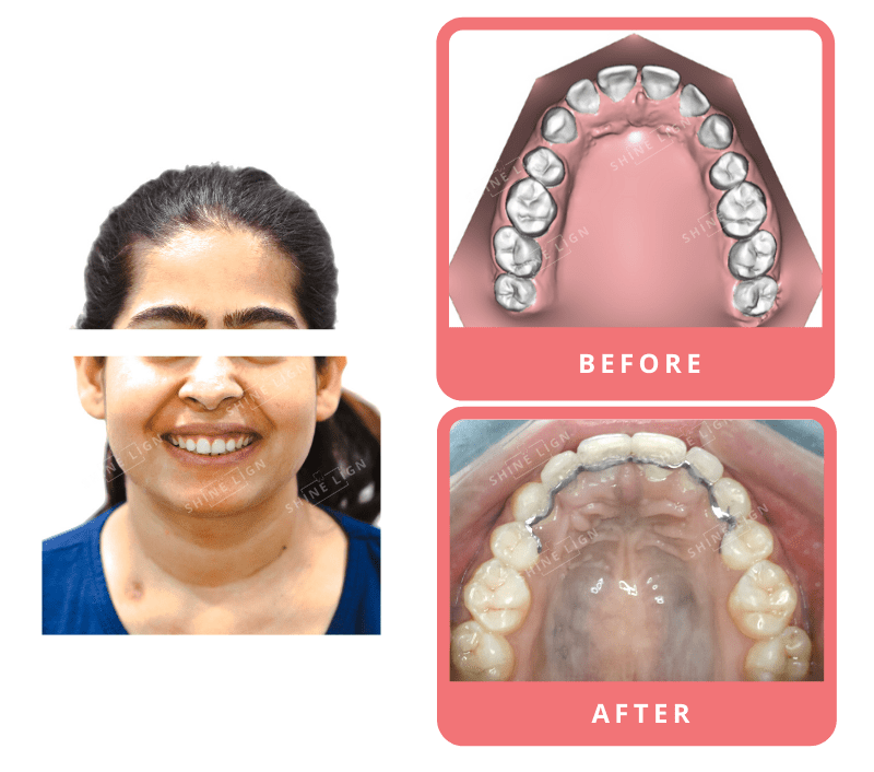 Shinelign Clear Aligner