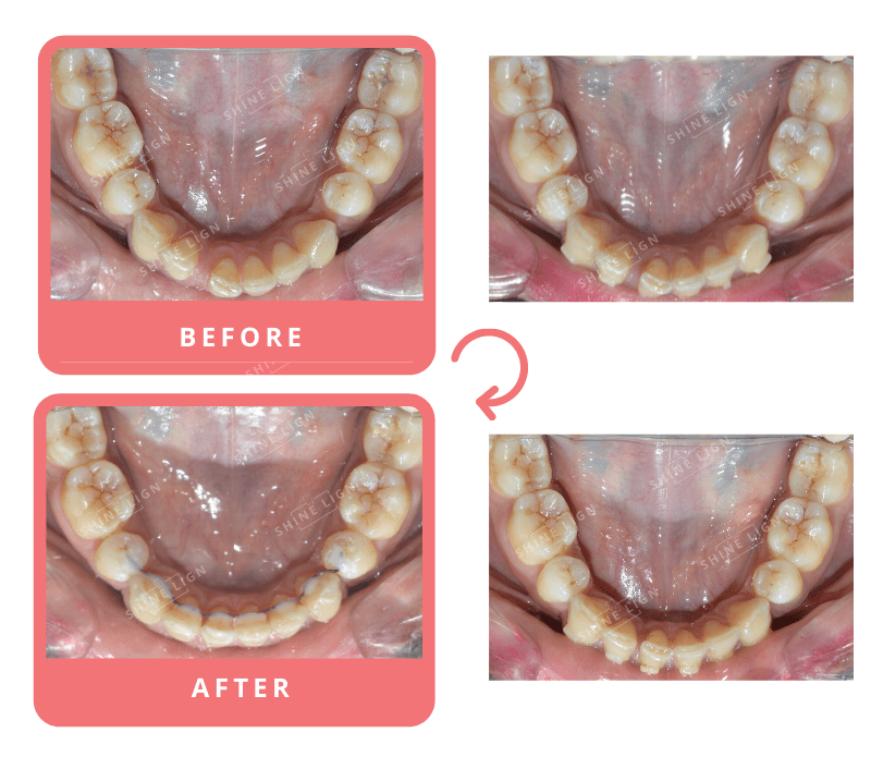 Shinelign Clear Aligner