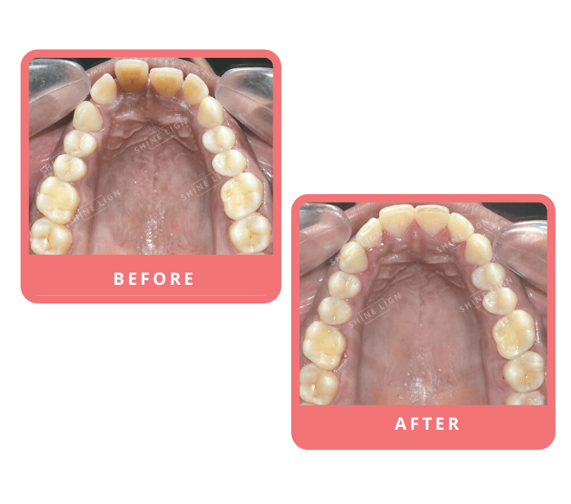 Shinelign Clear Aligner