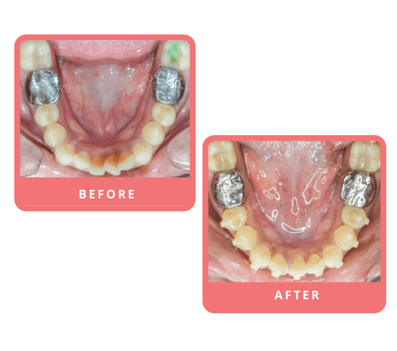 Shinelign Clear Aligner