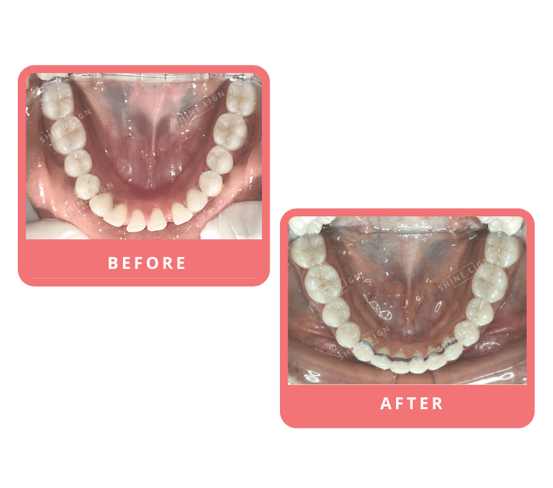 Shinelign Clear Aligner